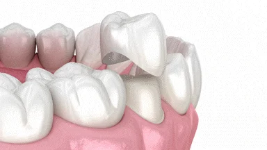 Prepared dental bridge structure