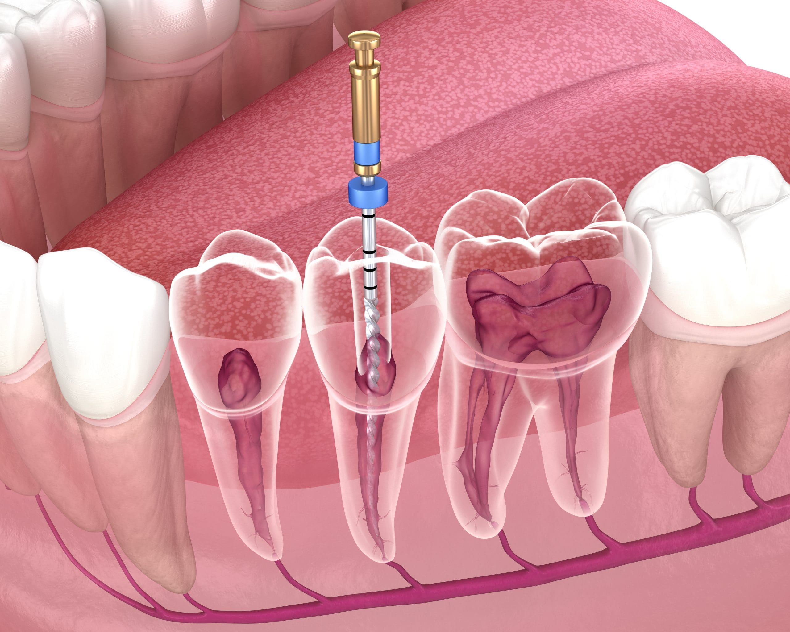 Professional dental restoration